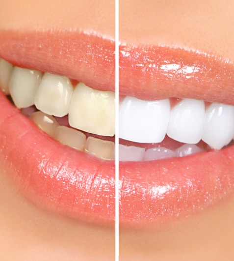 Teeth Whitening